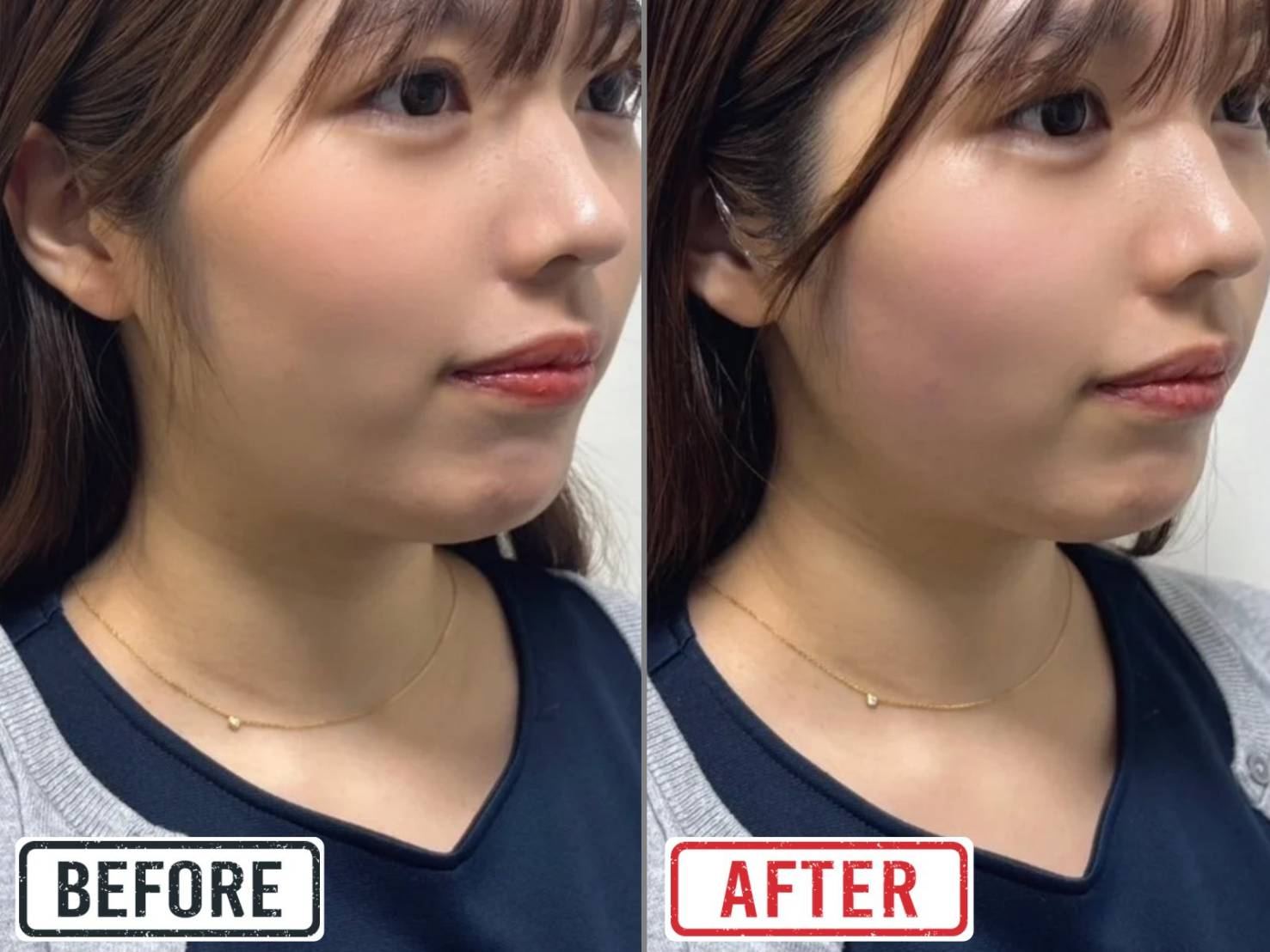 Face-Slimming Course before and after